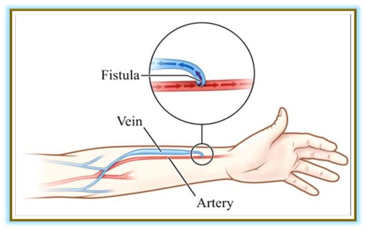 Hemodialysis (HD) - We Care