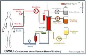 Continuous Veno-Venous Hemofiltration (CVVH)