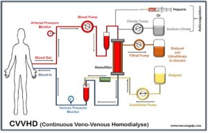 Continuous Veno-Venose Hemodialysis (CVVHD)