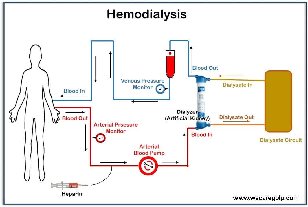 Hemodialysis (HD)