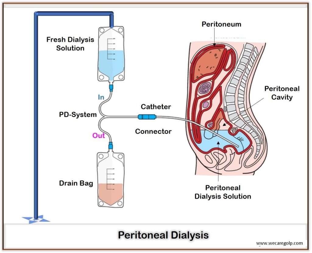 peritoneal-dialysis-we-care