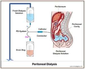 Peritoneal Dialysis