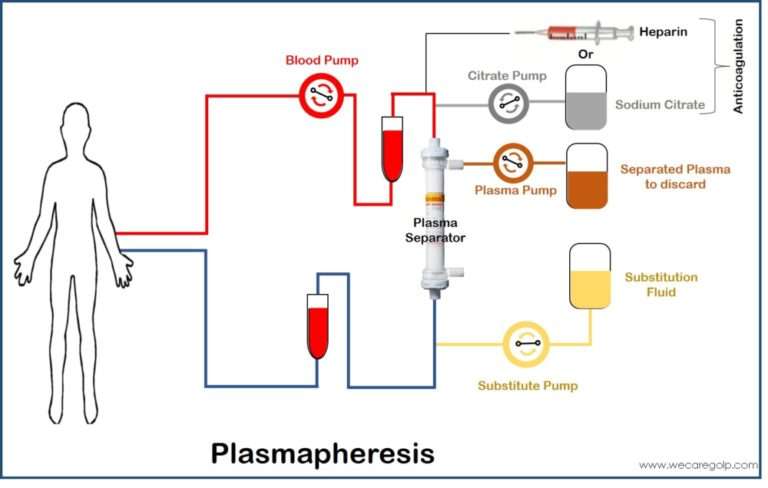 Plasmapheresis - We Care