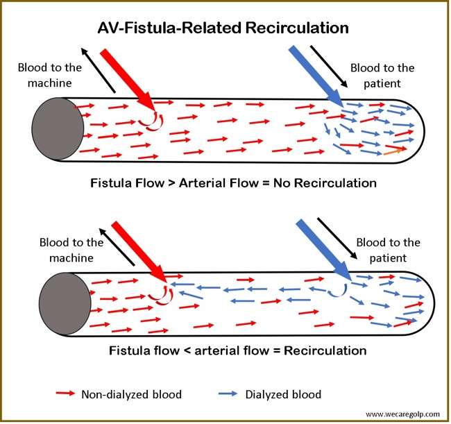 AV Fistula related Recirculation