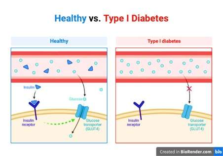 Type 1 diabetes mellitus