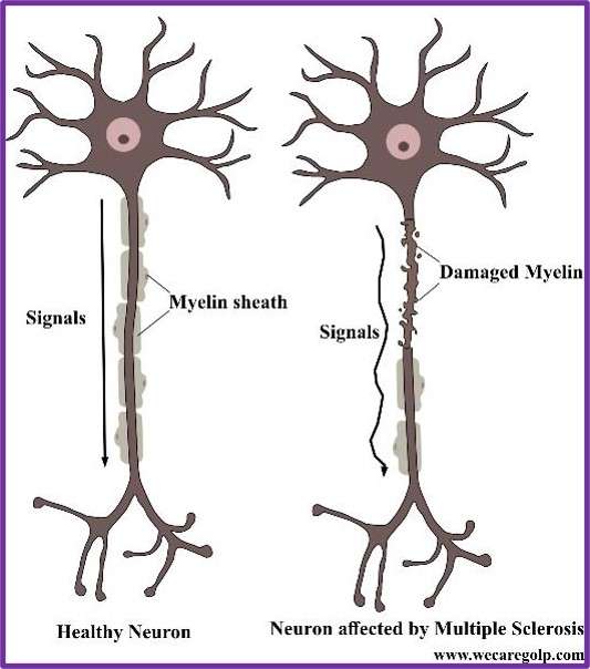 Neurons affected by Multiple Sclerosis