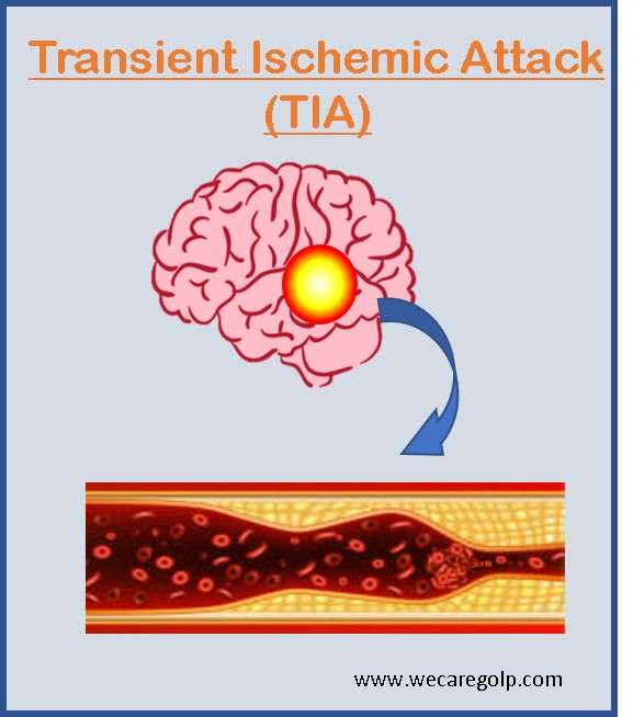 Transient Ischemic Attack