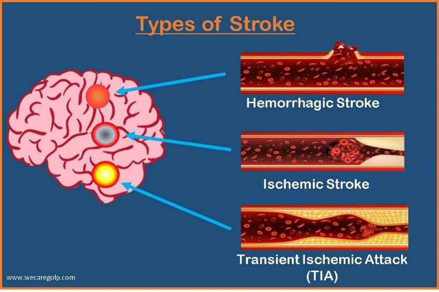 Types of Stroke