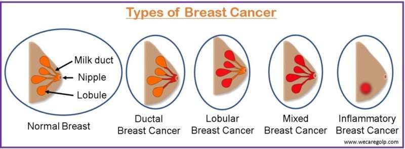 Breast Cancer: Types, Symptoms, Management - We Care