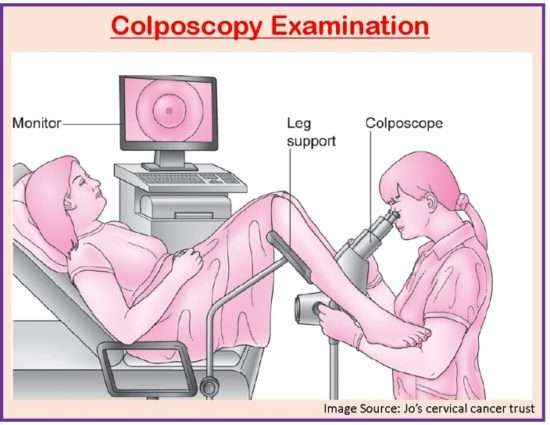 Colposcopy Examination