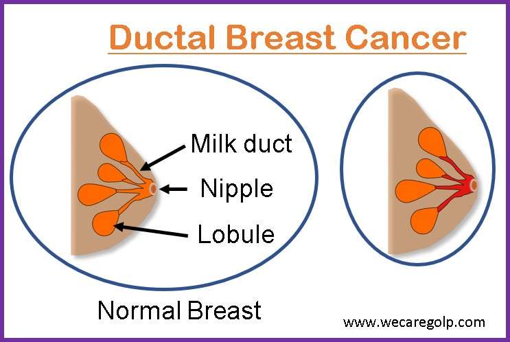 Ductal Carcinoma