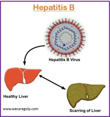 Hepatitis B