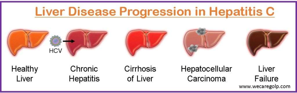 Liver Disease Progression in Hepatitis C