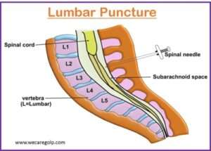 Lumbar Puncture (Spinal Tap) - We Care