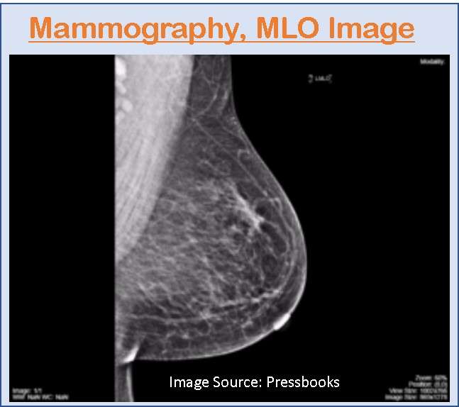 MLO Image, Mammography