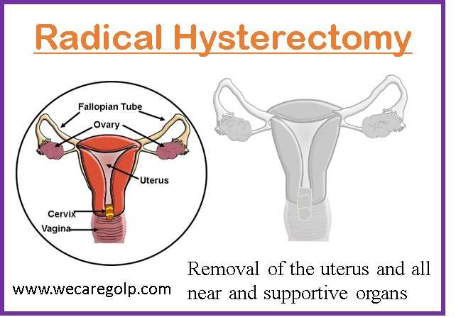 Radical Hysterectomy