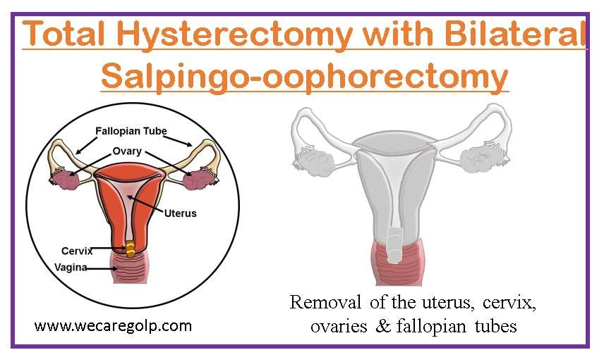 Salpingo-oophorectectomy