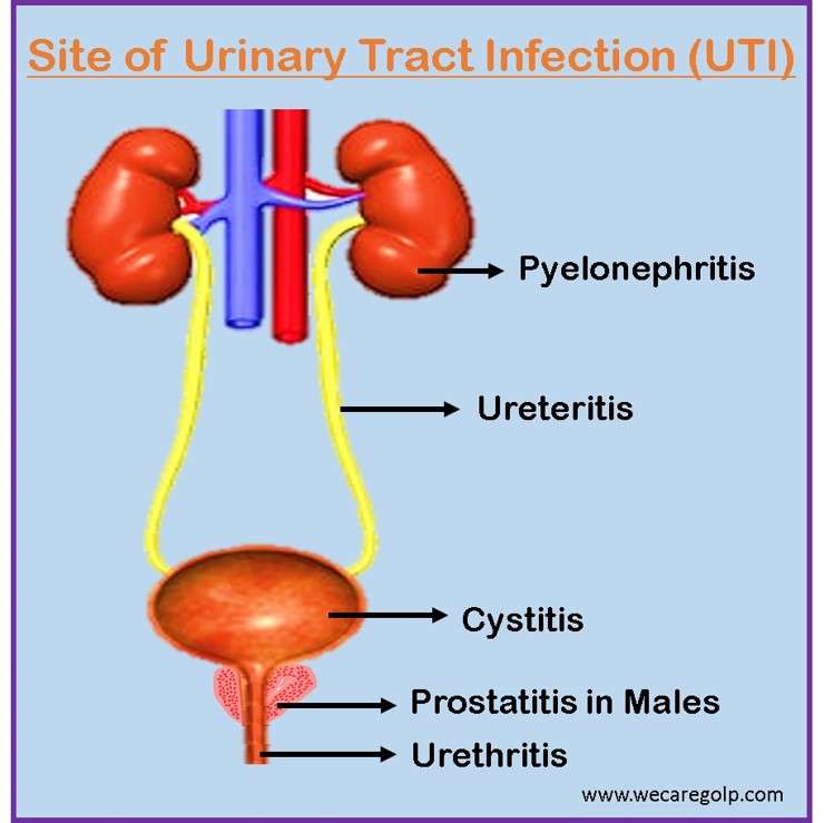 Site of Urinary Tract Infection (UTI)