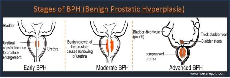 Benign Prostatic Hyperplasia (BPH) - We Care