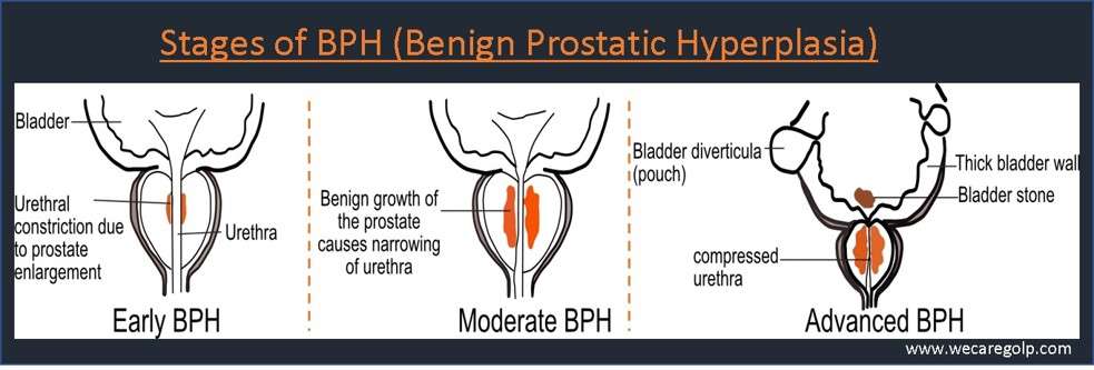 Stages of BPH