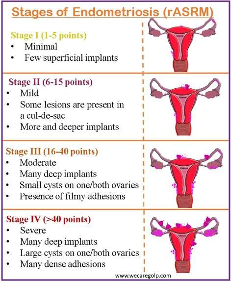 Stages of Endometriosis