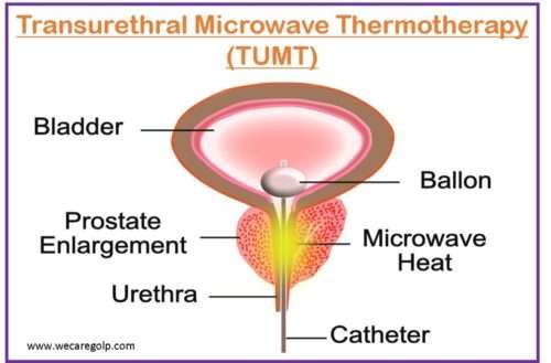 Transurethral Microwave Thermotherapy (TUMT)