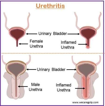 Urethritis: Causes, Signs and Symptoms, Management - We Care