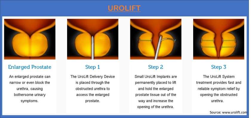 Urolift