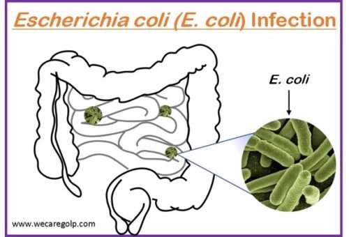 Escherichia coli Infection
