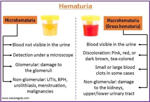 Hematuria Blood In The Urine We Care