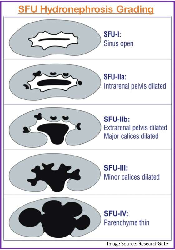 Hydronephrosis Urinary Tract Dilatation We Care Hydronephrosis Urinary Tract Dilatation We Care