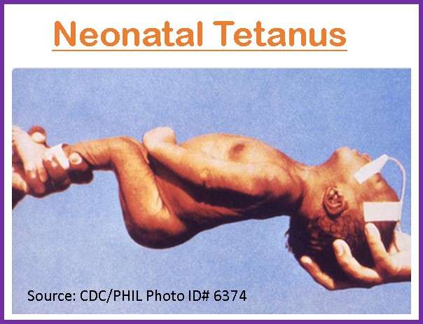 Neonatal Tetanus