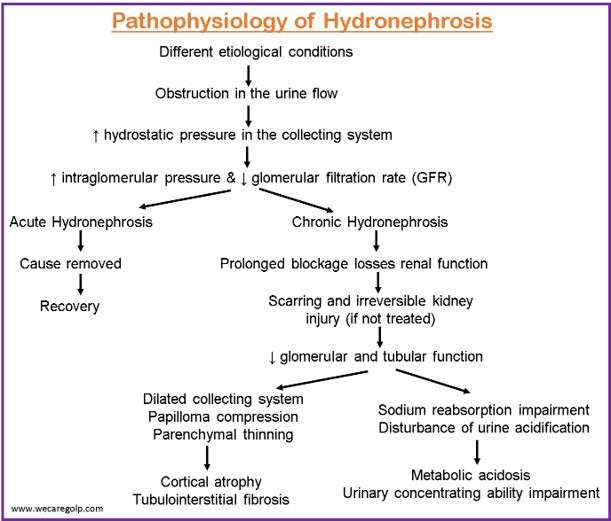 Pathophysiology of Hydronephrosis