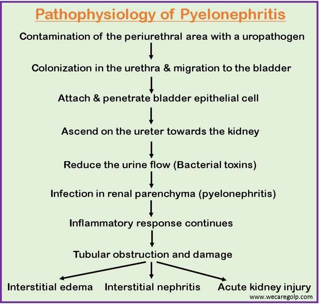 Pathophysiology Of Pyelonephritis Schematic Diagram Informative ...