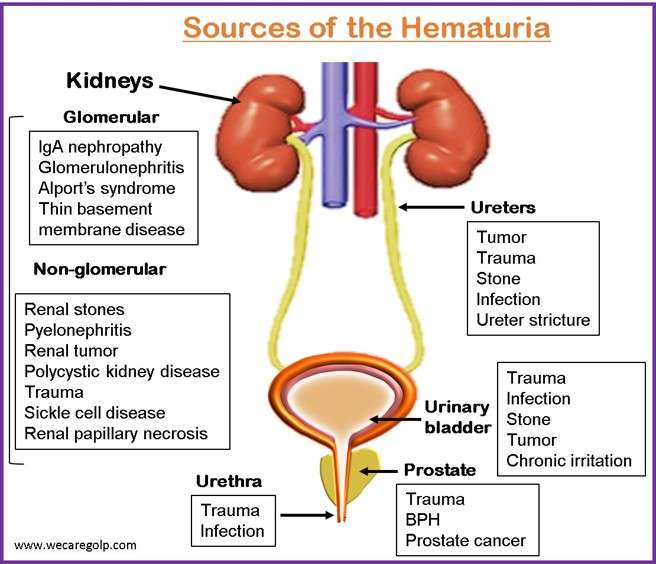 Sources of the Hematuria