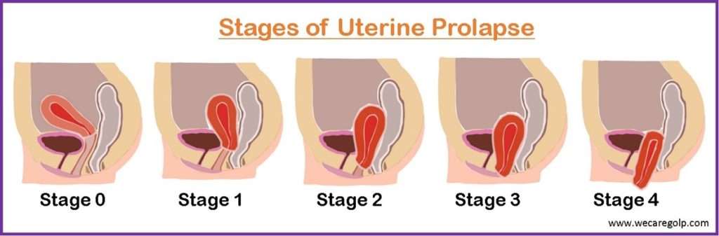 Stages of Uterine Prolapse