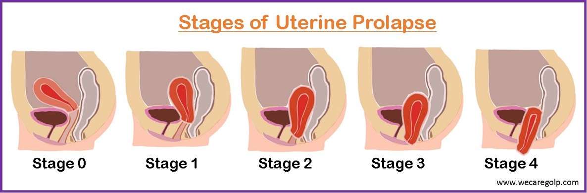 Uterine Prolapse Stages Symptoms Management We Care