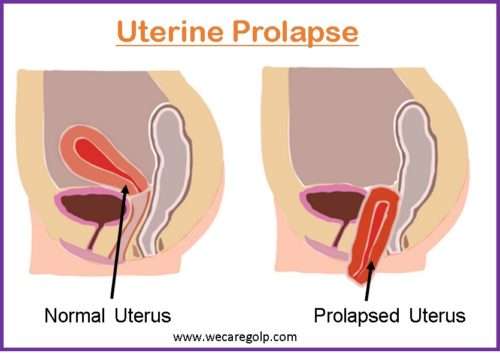 JCDR - Gravid uterus, uterine cervix, Uterine prolapse