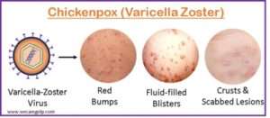 Chickenpox (Varicella-Zoster) - We Care