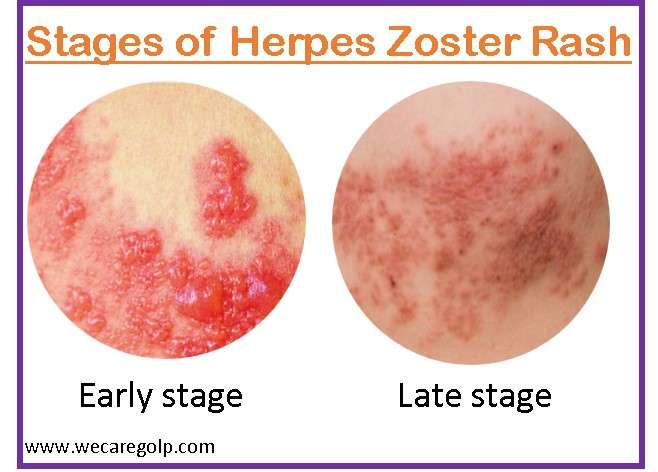 Early Signs And Symptoms Of Herpes Zoster In Guatemala City Mexico 