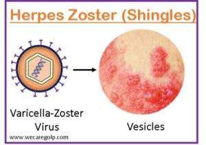 Herpes Zoster (Shingles) - We Care