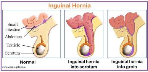 A: large femoral hernia in a female patient. B: the hernia sac