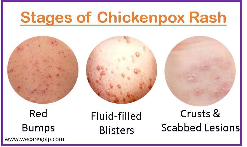 Stages of Chickenpox Rash