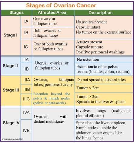 Stages of Ovarian Cancer