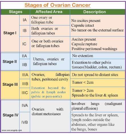 Ovarian Cancer: Symptoms, Diagnosis, Management - We Care