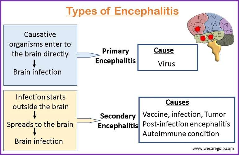 Types of Encephalitis