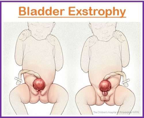 bladder exstrophy in adults