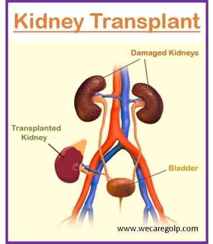 Kidney (Renal) Transplant