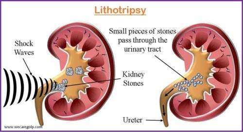 Lithotripsy