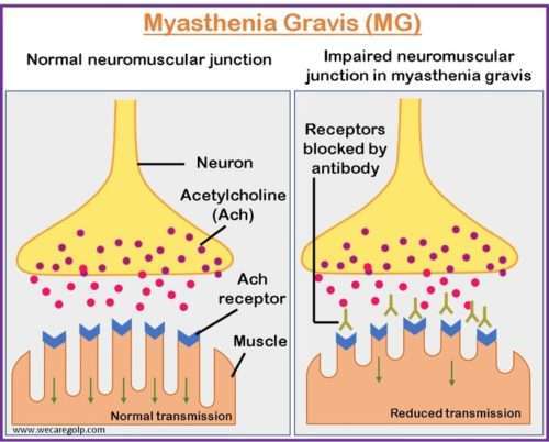 Myasthenia Gravis Gmg Myasthenia Gravis YOYQ Myasthenia Gravis Gmg Myasthenia Gravis YOYQ